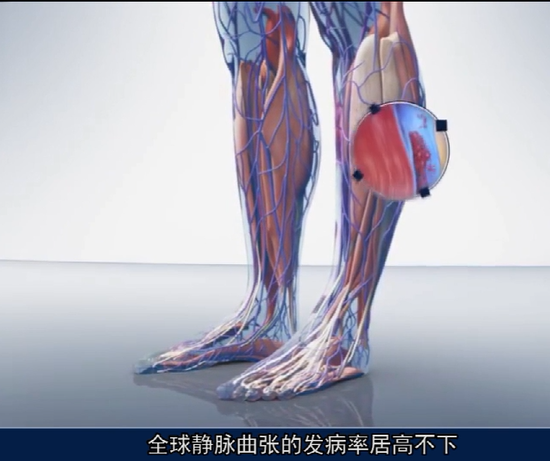如何根据腿部症状选择正确的医用弹力袜？(图3)